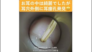 142 ＃耳掃除耳かきearwax【耳瘻孔 発見！すぽっとポイント、何回かあります】 [upl. by Assirim633]