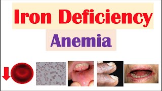 IronDeficiency Anemia Overview  Causes Pathophysiology Signs amp Symptoms Diagnosis Treatment [upl. by Wehrle888]