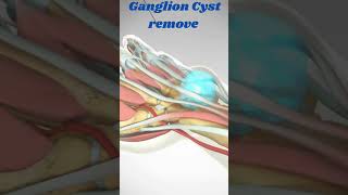 Ganglion Cyst remove viral ganglioncystbiology3danimation crazypharmaguruji1331 [upl. by Mandler]