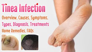 Tinea overview causes sign and symptoms diagnosis treatment home remedies and FAQs [upl. by Dray296]