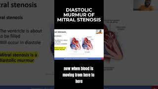 Diastolic Murmur of Mitral Stenosis  MCCQE1 [upl. by Anigar]