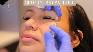 Botox Brow Lift [upl. by Shuler429]