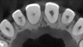 Management of a sclerotic maxillary central incisor associated with a periapical lesion [upl. by Ahsuoj]