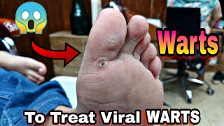 Warts To Treat Viral infection Treatment  Footcare33 [upl. by Aidua640]