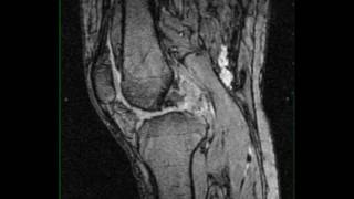 Pigmented Villonodular Synovitis Knee [upl. by Noiztneb]