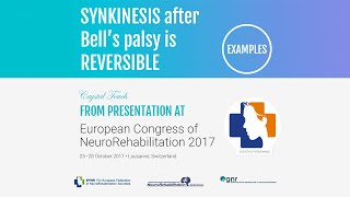 Synkinesis is reversible Examples From presentation on ECNR2017 Lausanne Switzerland [upl. by Flita745]