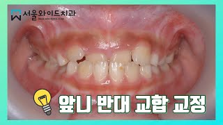 강동구 치과 앞니 반대교합 교정 치료  anterior crossbite treatment correction class III 2x4 orthodontic app [upl. by Gilford]