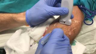 Ultrasound Guided Peripheral IV Insertion  quotOutofplanequot Approach [upl. by Odama783]