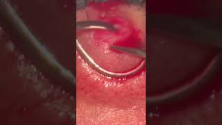 Chalazion surgery Chalazion Expert Advice for Quick Healing [upl. by Imoian]