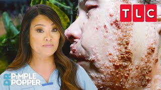 Strangest Skin Conditions  Dr Pimple Popper  TLC [upl. by Harwell]