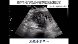 Uterine Fibroids MWA Ablation by Dr Honghui Su [upl. by Adleme]