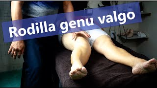 Rodilla en genu valgo [upl. by Wrdna]