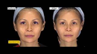 Ellanse procedure at ShangLi Dermatologic amp Aesthetic Clinic [upl. by Smail457]