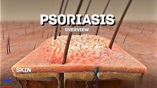 Psoriasis Overview [upl. by Ardiekal789]