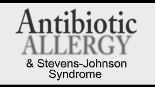 3 Errors Causing AntiBiotic Allergy amp StevensJohnson Syndrome [upl. by Atnahs506]