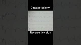 ECGDigoxin toxicity [upl. by East196]