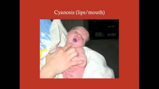 Surgery of Cyanotic CHDs  CRASH Medical Review Series [upl. by Parke132]