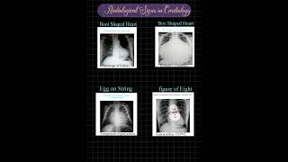 RADIOLOGICAL SIGNS IN CARDIOLOGY Mnemonic [upl. by Ronaele]