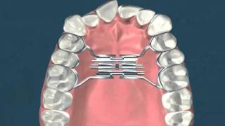 Expasion palatina rapida  Ortodoncia [upl. by Astraea]