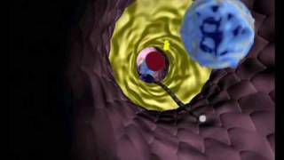 Artherosclerosis  animation on inserting a stent [upl. by Bowyer457]