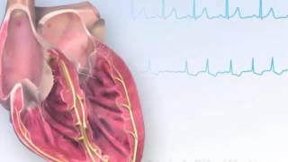 American Heart Association AHA Atrial Fibrillation Animation [upl. by Bouton47]