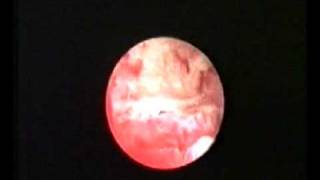 hysteroscopic treatment of osteoid metaplasia [upl. by Elata]