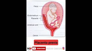 Placenta previa [upl. by Syla]