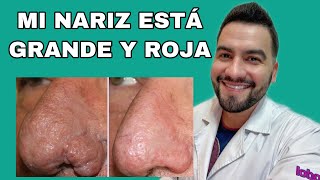 TENGO MI NARIZ GRANDE Y ROJA  RINOFIMA  ROSACEA  DR DAVID CAMPOS [upl. by Assela802]