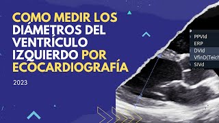 📌Como medir 📏 DIAMETROS DEL VENTRÍCULO IZQUIERDO por ECOCARDIOGRAFÍA [upl. by Buroker]