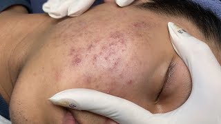 ACNE TREATMENT VU QUYNH MI Acne On Teens Chin 2024 [upl. by Aicilec]