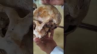 Introduction to infratemporal fossaanatomy cnsviral mbbsstudent medical viralvideo foryou [upl. by Aehcim555]