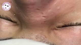 Acne facial removal treatment by Sopheaskincarecambodia 29 August 2023 [upl. by Eilla]