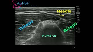 Radial Nerve Block Ultrasound Guided [upl. by Urbani]