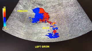 Ultrasound cases pseudoaneurysm  common femoral artery [upl. by Heydon]