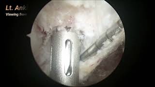 Arthroscopic Anterior TaloFibular Ligament Repair of the Ankle [upl. by Isobel]