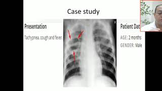 Case 42 post pneumonic pneumatocele thin wall cystic space or lung lesion [upl. by Juakn349]