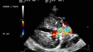 stenosi subaortica grave Lagotto subaortic stenosis [upl. by Shell]