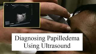 Using Ultrasound to Diagnose Papilledema [upl. by Urita]