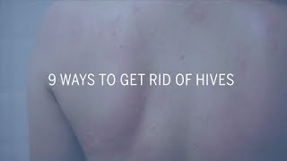 9 Ways to Get Rid of Hives  Health [upl. by Ginzburg452]