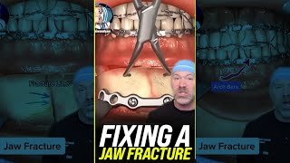 Fixing a Jaw Fracture 😱 shorts [upl. by Oiramat]