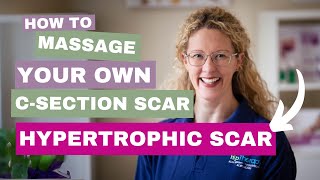 Scar Therapy  Techniques  Hypertrophic Scars  CSection Scarring and Recovery with HLP Therapy [upl. by Tavis]