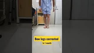 bow legs corrected [upl. by Yeliah]