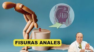 Las Fisuras Anales  Todo lo que querías saber [upl. by Bogusz]