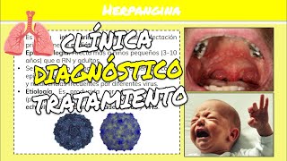 ⚕️🩺 HERPANGINA Infecciones Respiratorias Agudas Síntomas Diagnóstico y Tratamiento [upl. by Temple397]