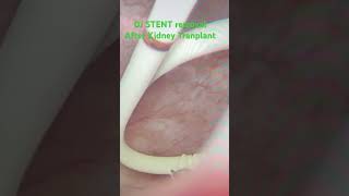 Inside operation DJ stent removal after kidney transplant [upl. by Atal]