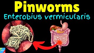 Pinworms Threadworms Symptoms Causes Treatments Life Cycle – Enterobius vermicularis [upl. by Ogaitnas670]