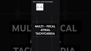 multifocal atrial tachycardia  ECG basics [upl. by Gargan]