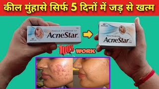 acnestar gel review एक्ने पिंपल्स जड़ से खत्म करने की दवा acnestar gel kaise use kare  acnestar [upl. by Nylloc749]