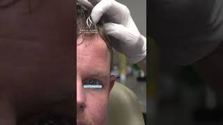 Endoscopic Forehead Osteoma Removal Dr Niamtus Case cosmeticsurgeon medicaleducation osteoma [upl. by Roos]