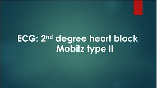 ECG 2nd degree heart block Mobitz type II [upl. by Earej]